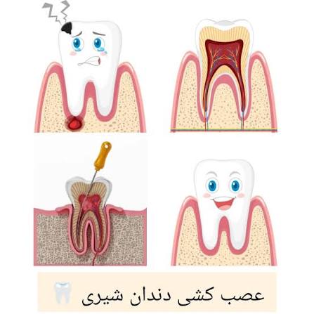 عصب کشی دندان شیری